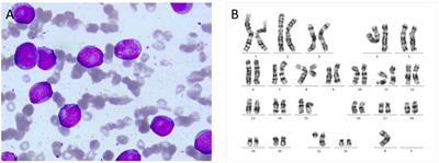 Long-term survival in a patient with primary refractory AML after salvage allogeneic hematopoietic transplantation and post-transplant localized irradiation and venetoclax maintenance: a case report